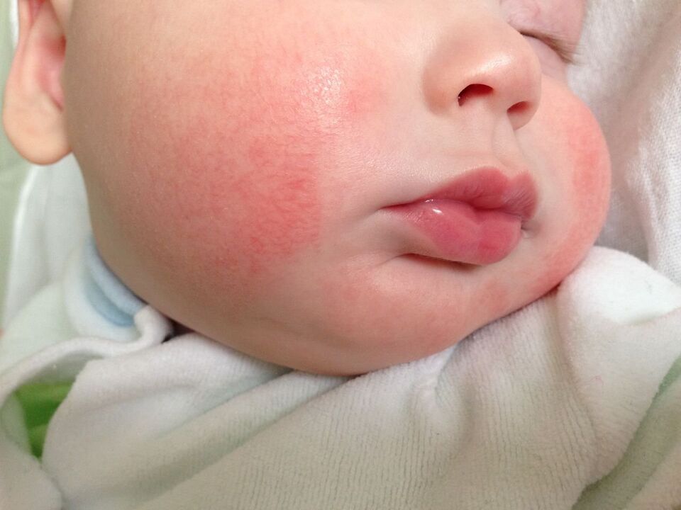 Un signe de vers chez un enfant est l'urticaire allergique